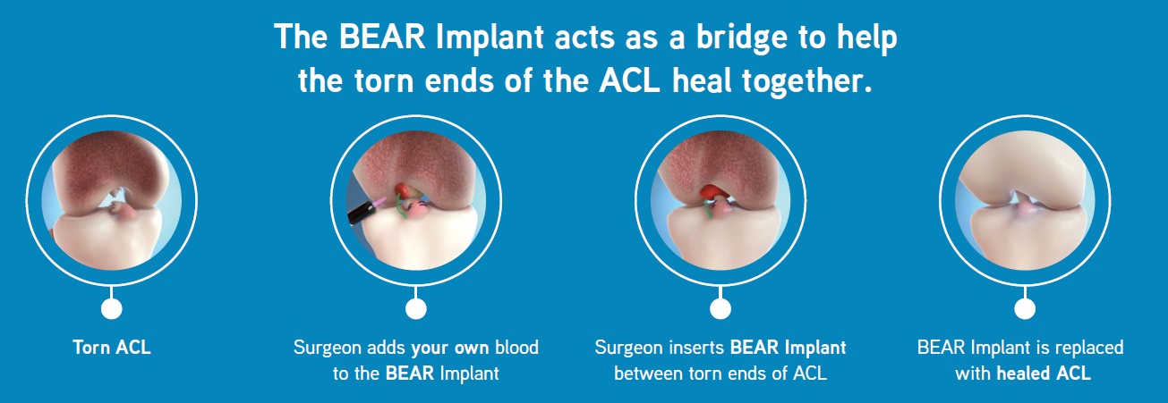BEAR® Implant for ACL Restoration | United Health Services
